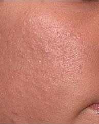 dermabraziya_04.jpg