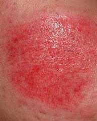 dermabraziya_02.jpg