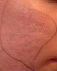 dermabraziya_01.jpg
