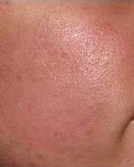 dermabraziya_03.jpg